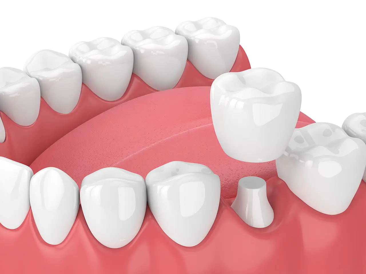 Dental Crown Repair in Amarillo: What to Do When a Crown Feels Loose, Chipped, or Falls Off