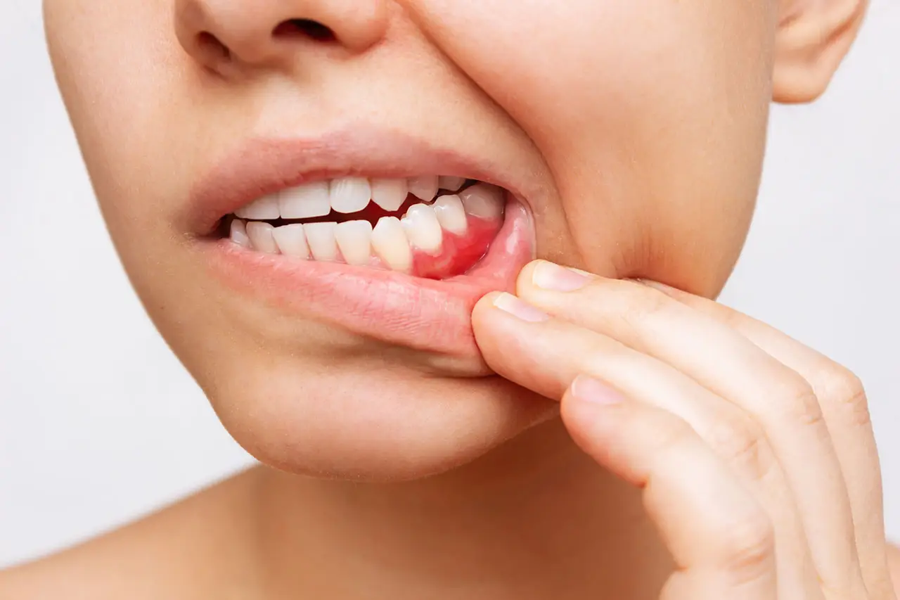 Gum Recession in Amarillo: Why Roots Become Exposed and How Recession Protection Can Help