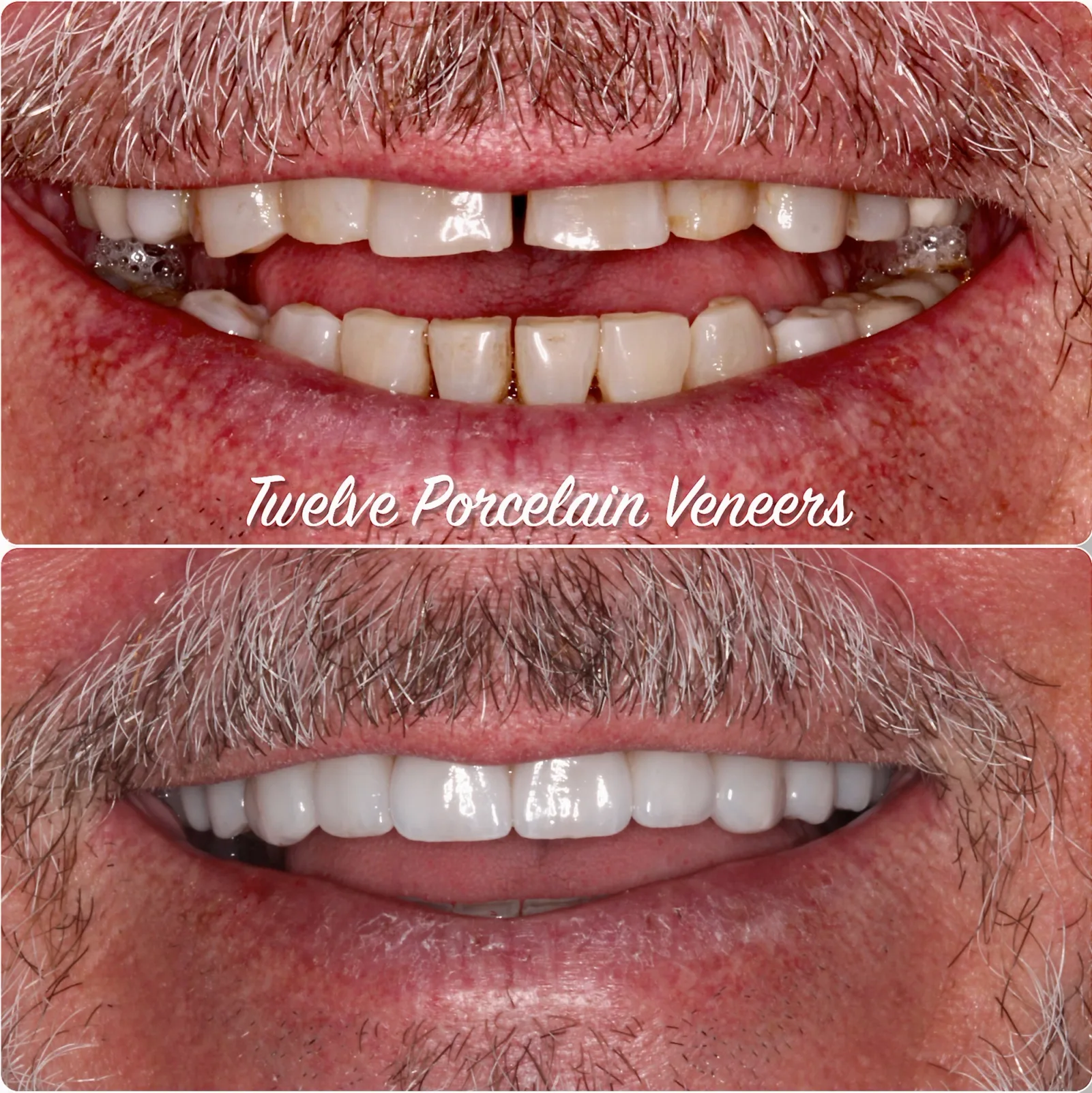 a picture of a man 's teeth before and after porcelain veneers