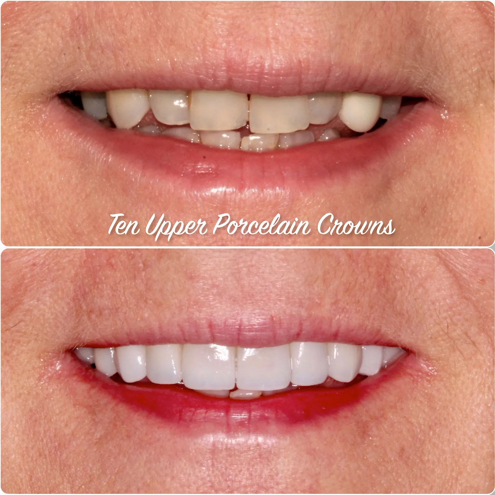 a before and after photo of a woman 's teeth with porcelain crowns .