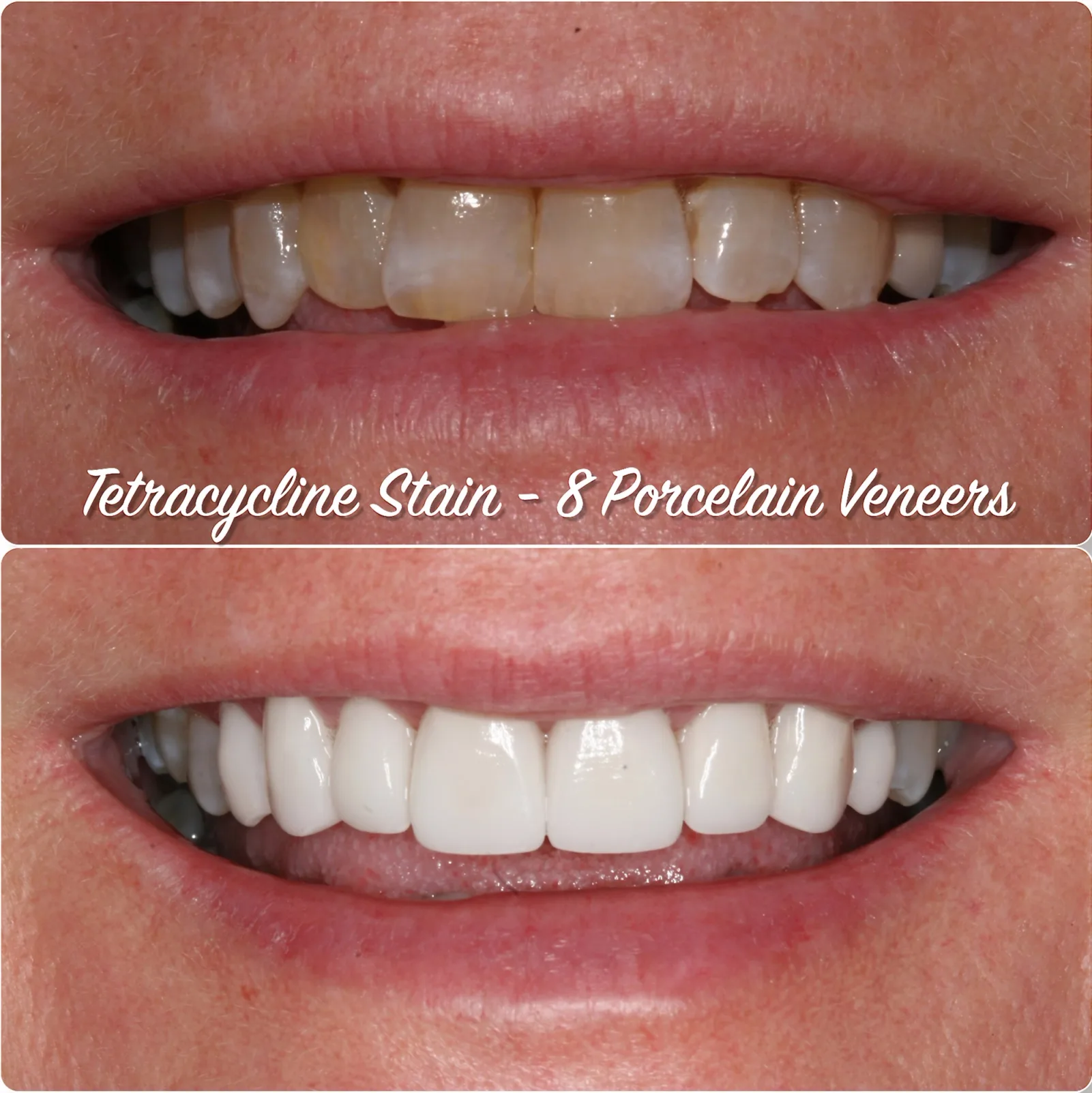 a before and after photo of a woman 's teeth with tetracycline stain and porcelain veneers