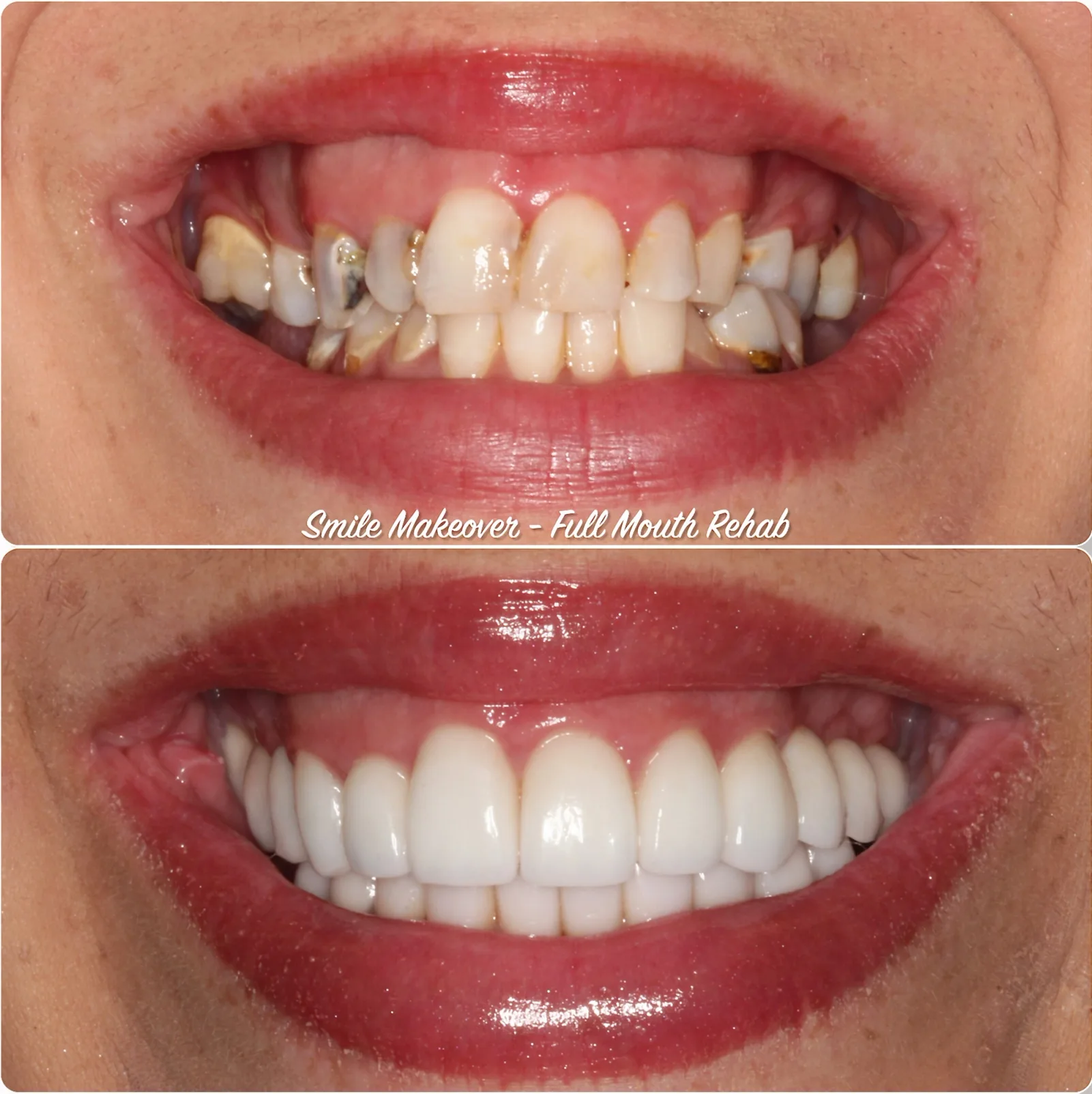a before and after photo of a smile makeover full mouth rehab