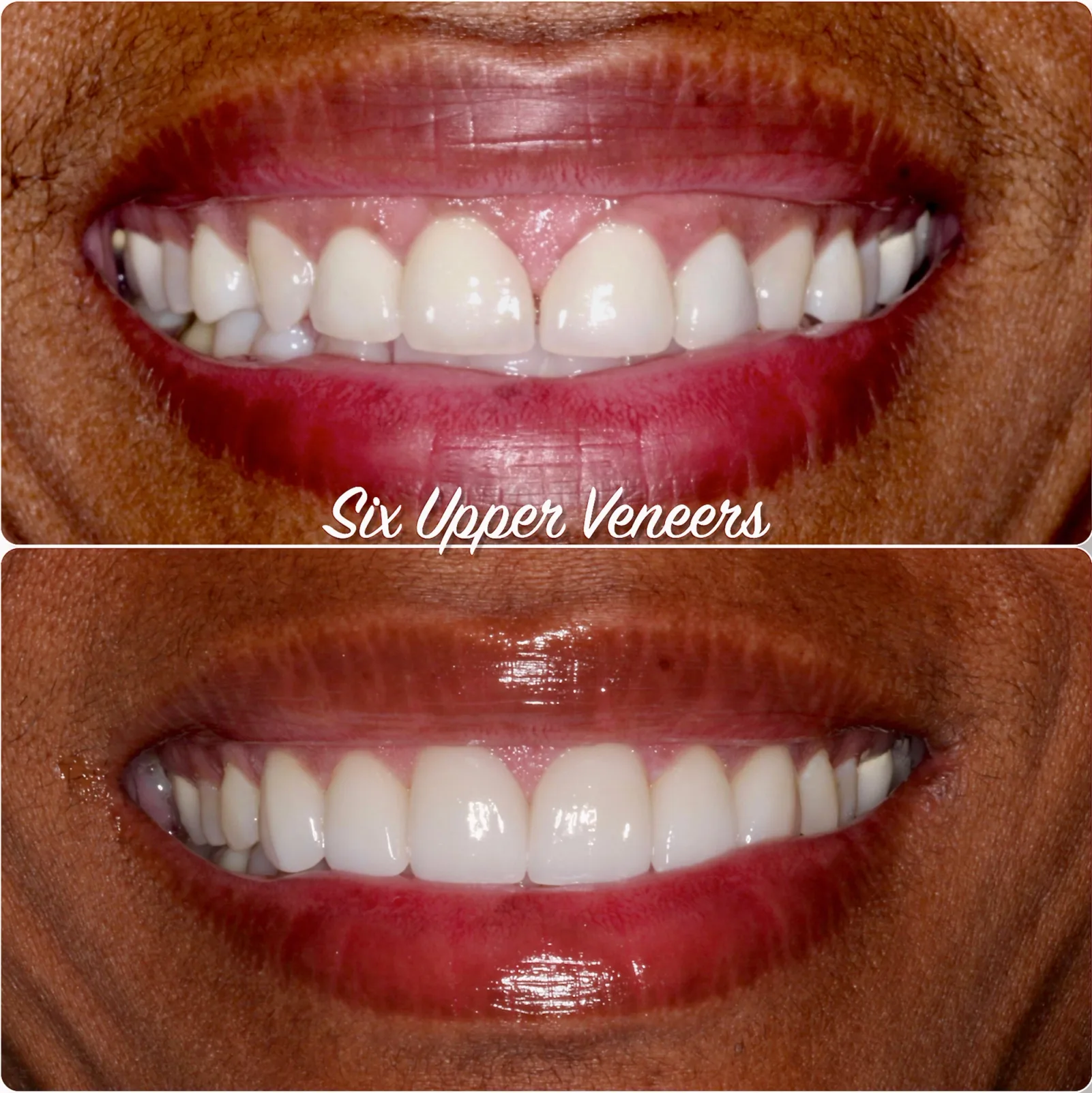 a before and after photo of a woman 's teeth with six upper veneers .
