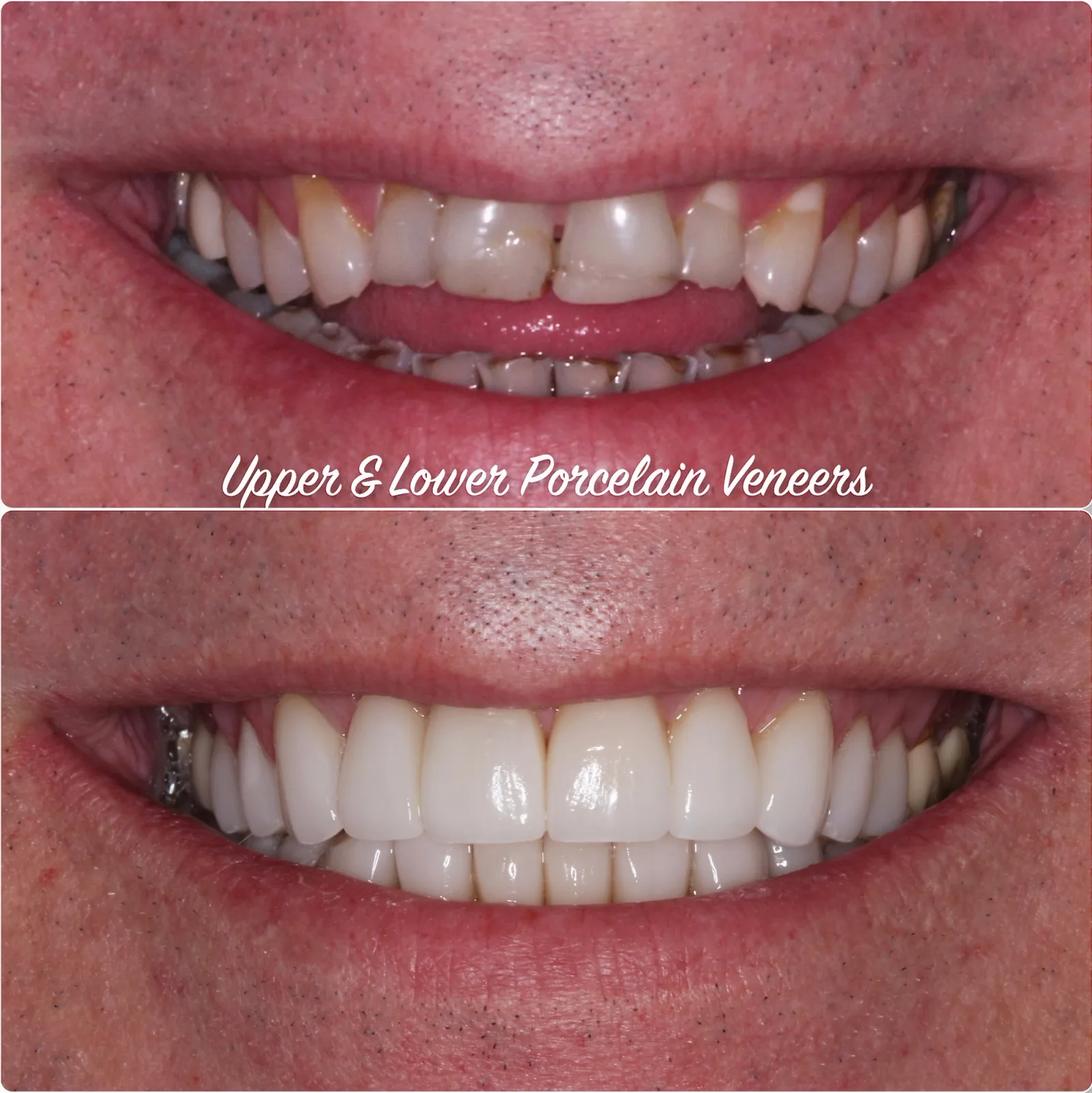 a before and after photo of a person 's teeth with porcelain veneers .