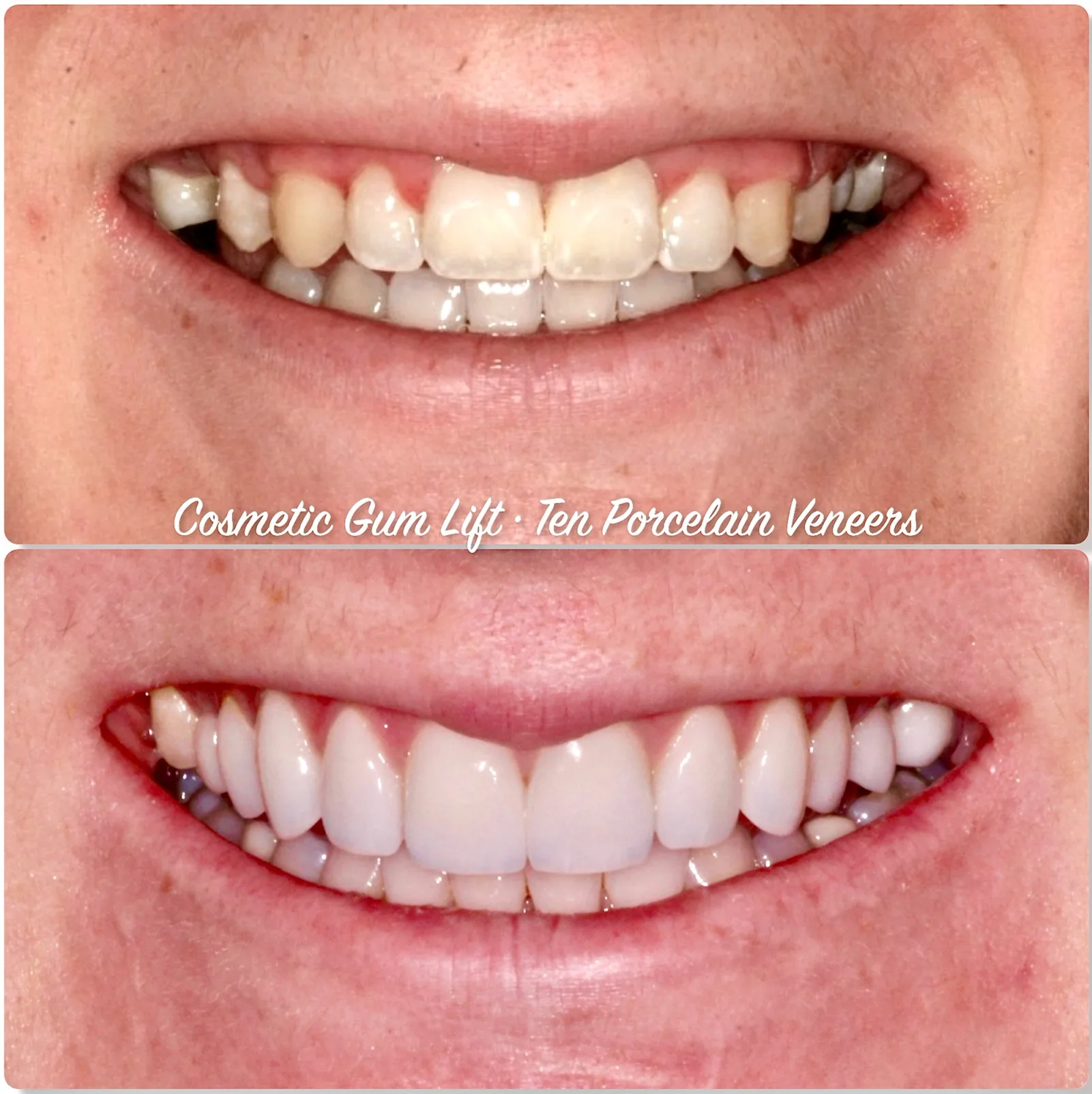 a woman 's teeth before and after cosmetic gum lift