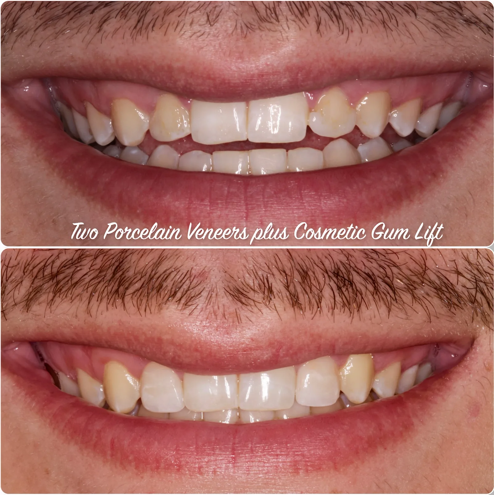 a before and after photo of a man 's teeth with the caption " two porcelain veneers plus cosmetic gum lift "