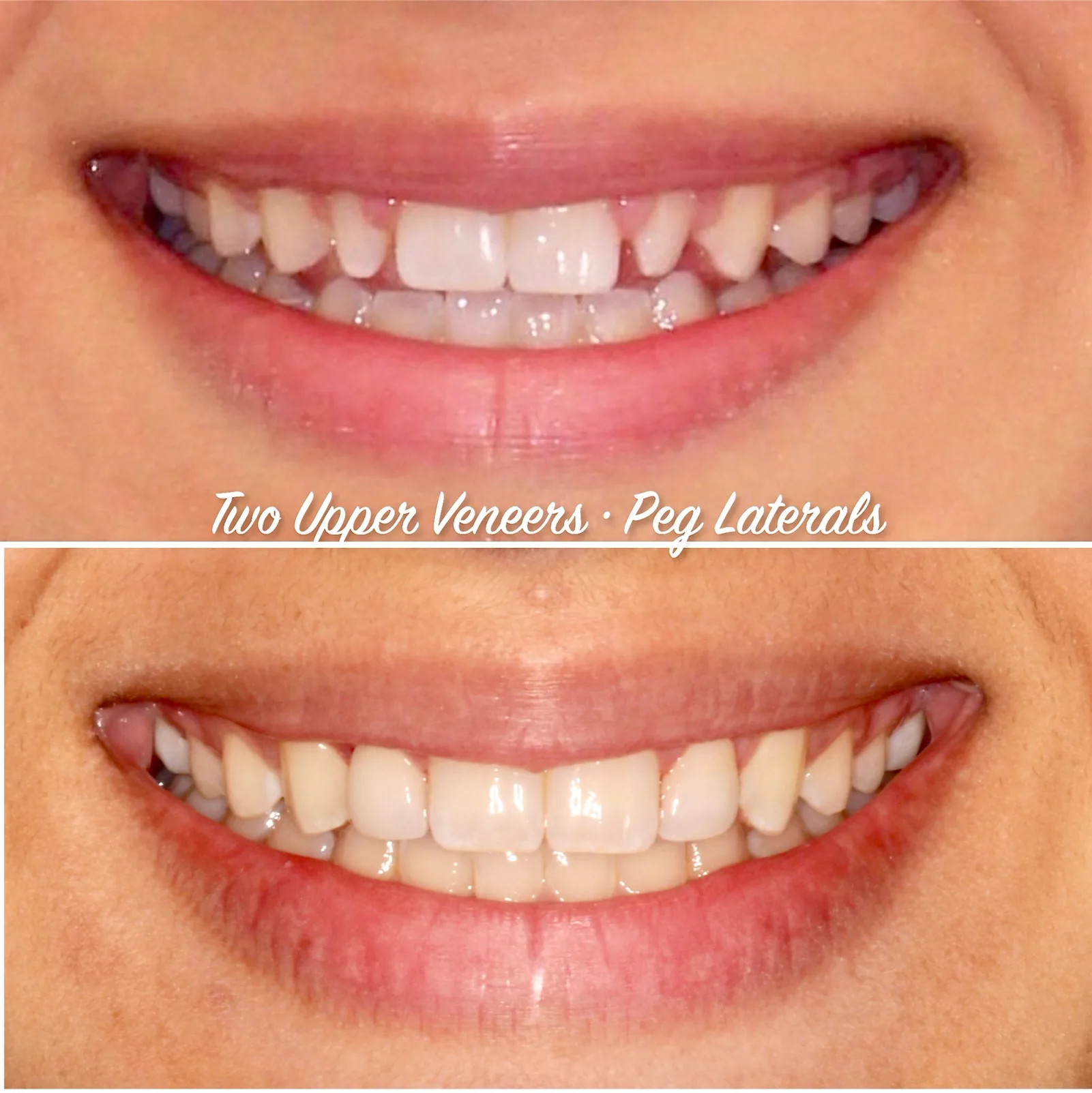 a before and after photo of a woman 's teeth with two upper veneers and peg laterals