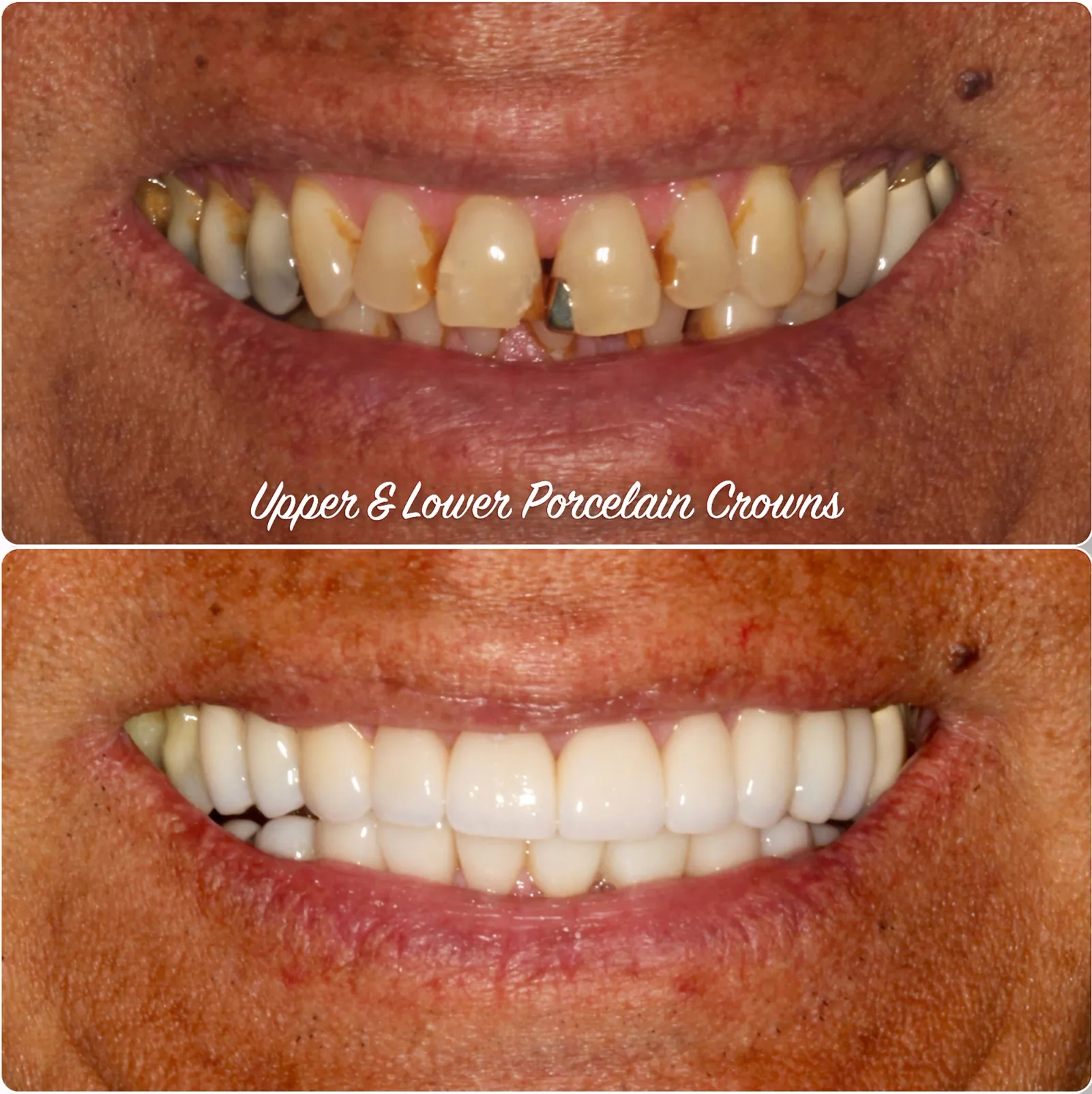 a before and after photo of a person 's teeth with upper and lower porcelain crowns .