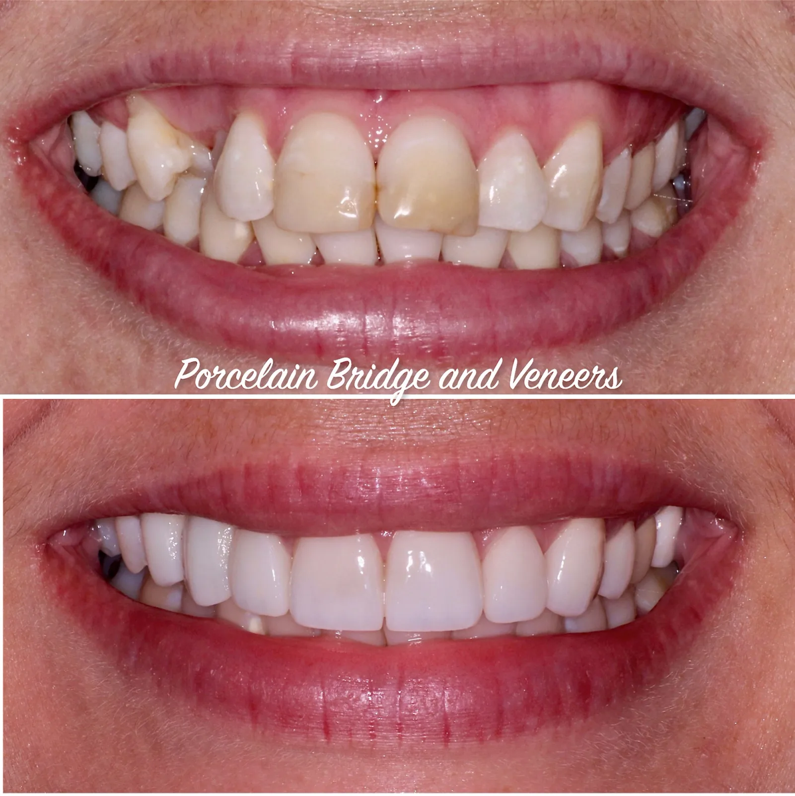 a before and after photo of a woman 's teeth with porcelain bridges and veneers .